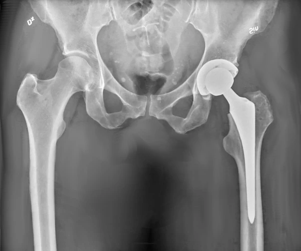 Hip replacement X-Ray