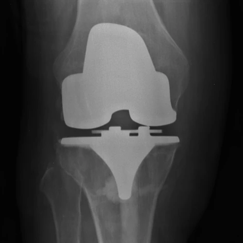 Knee implant X-Ray