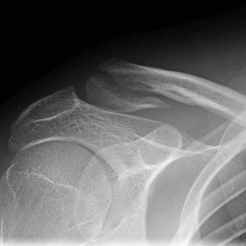 Shoulder X-Ray